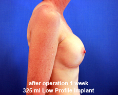 plastic-surgery-breast-augmentation